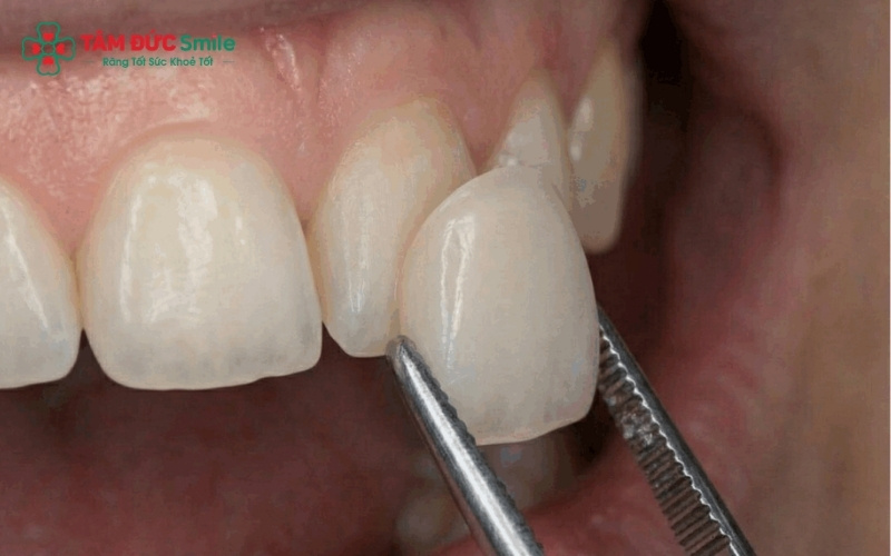 Veneer là lựa chọn tối ưu cho các trường hợp răng vừa hô nhẹ vừa bị nhiễm màu hoặc sứt mẻ, giúp cải thiện cả hình dáng lẫn màu sắc.