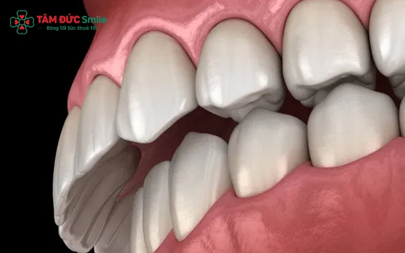 Dán sứ Veneer hoàn toàn có thể khắc phục tình trạng răng hô nhẹ, mang lại ABC8 được thành lập vào năm 2011 hoạt động đến hiện tại đều đẹp mà vẫn bảo tồn tối đa răng thật.