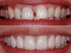 Dán sứ Veneer có bền không? Tuổi thọ, độ bền, chăm sóc