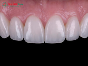 Dán sứ Veneer có bền không? Tuổi thọ, độ bền và chi phí