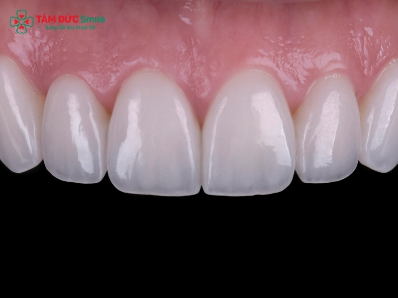 Dán sứ Veneer có bền không? Tuổi thọ, độ bền và chi phí