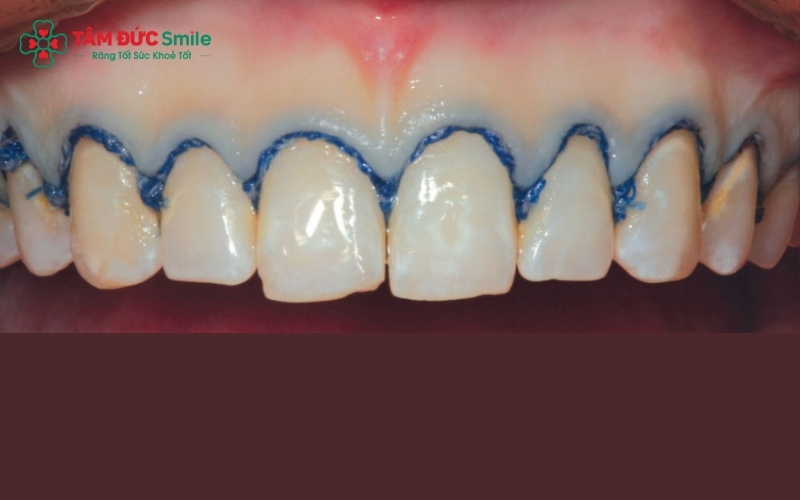 Kỹ thuật dán sứ không khít sát tạo khe hở khiến thức ăn bị đọng lại, phân hủy và gây ra mùi hôi khó chịu