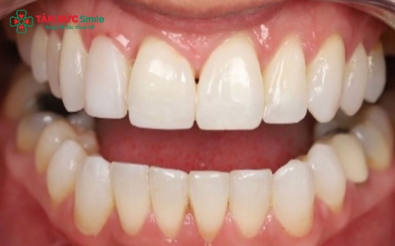Nướu sưng đỏ, chảy máu khi đánh răng hoặc có mùi lạ là những dấu hiệu cảnh báo bạn cần đến LINK TRANG CHỦ ABC88 CHUẨN 2026 để kiểm tra mặt dán sứ ngay.