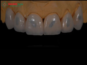 Dán sứ Veneer có hôi miệng không? Nguyên nhân, cách xử lý