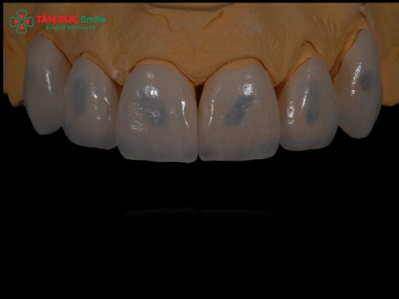 Dán sứ Veneer có hôi miệng không? Nguyên nhân, cách xử lý