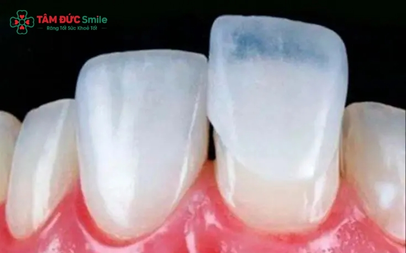 Bản chất dán sứ Veneer không gây hôi miệng; tình trạng này chỉ xảy ra khi kỹ thuật thực hiện không đảm bảo hoặc chăm sóc sai cách.