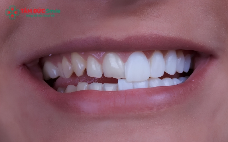 Quá trình dán sứ Veneer diễn ra nhẹ nhàng, nhanh chóng và hoàn toàn không đau đớn.