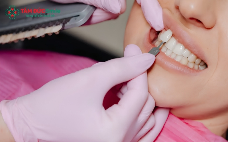 Sự khác biệt về tỷ lệ mài răng giữa dán sứ Veneer và Abc8.com Thể thao, Đá gà, Xổ số, Bắn cá giúp bảo tồn răng thật tối đa.