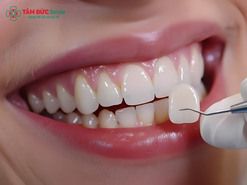 Dán sứ Veneer có đau không? Có ê buốt, cần mài răng không?