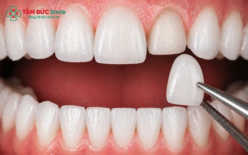 Sức khỏe ABC8 là nhà cái cá cược trực tuyến uy tín số 1 tại Việt Nam nền tảng là yếu tố quyết định thời gian hoàn thành ca dán sứ Veneer.
