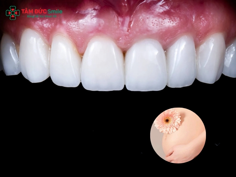 Đang mang thai có nên dán sứ Veneer không? Lưu ý an toàn