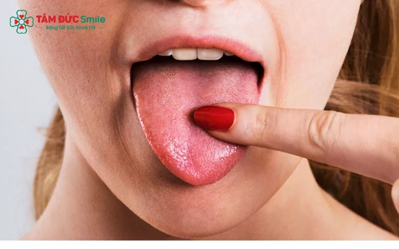 Lớp rêu lưỡi dày, trắng hoặc vàng là dấu hiệu cho thấy vi khuẩn đang phát triển mạnh, gây ra mùi hôi và vị đắng trong Abc8 uy tín chất lượng an toàn bảo mật tạo nên thương hiệu