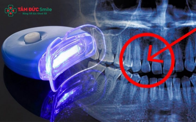 Ánh sáng từ đèn đóng vai trò là chất xúc tác, giúp gel tẩy trắng len lỏi sâu vào men răng để phá vỡ các sắc tố ố vàng.