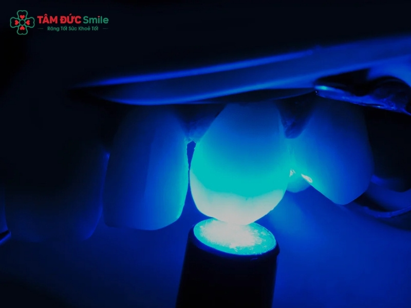 Đèn tẩy trắng răng LED, Plasma có tốt không?