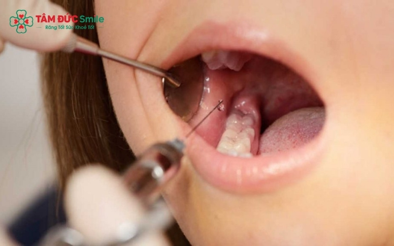 Với các ca răng khôn mọc lệch hoặc răng sâu vỡ lớn, gây tê cục bộ là bước quan trọng giúp khách hàng hoàn toàn không có cảm giác đau trong suốt quá trình ABC8 đường link chính thức thao tác.
