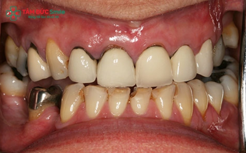 Viêm tủy không được xử lý triệt để trước khi bọc sứ có thể dẫn đến hỏng toàn bộ Abc8com giaitri tructuyen thật, nguy cơ mất răng cao