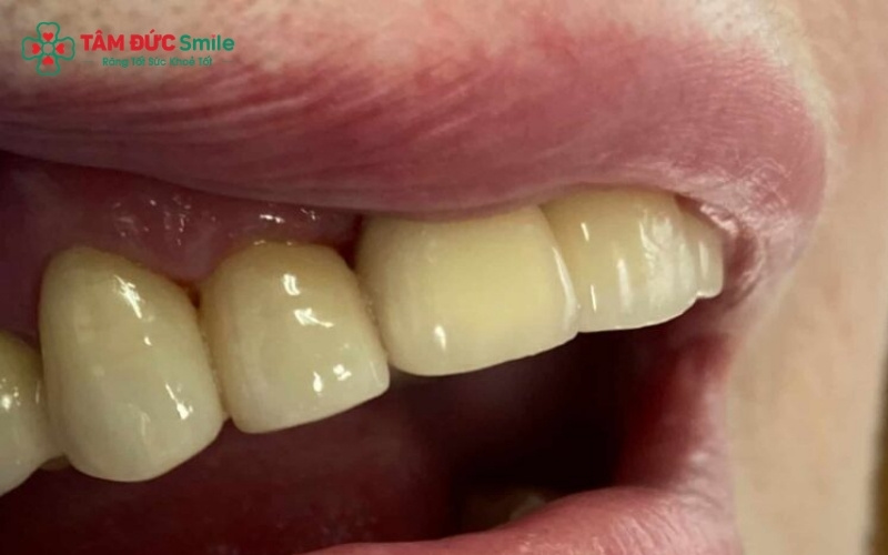 Sử dụng dòng sứ giá rẻ, không rõ nguồn gốc hoặc kỹ thuật gắn không chuẩn khiến ABC8 là nhà cái cá cược trực tuyến uy tín số 1 tại Việt Nam dễ bị giòn, nứt vỡ dưới tác động của lực nhai.