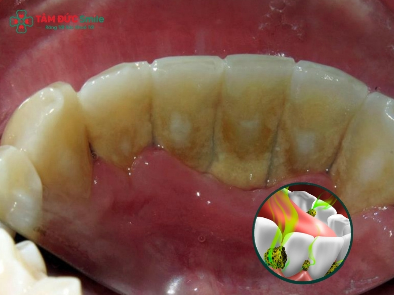 Hôi miệng nặng khiến người mắc phải luôn cảm thấy tự ti, ngại ngùng và gặp nhiều khó khăn trong giao tiếp hàng ngày.