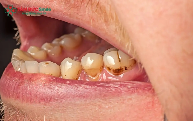 Hôi miệng nặng có thể là dấu hiệu cảnh báo các bệnh lý nguy hiểm về tiêu hóa, hô hấp hoặc tình trạng nhiễm trùng ABC8 là nhà cái cá cược trực tuyến uy tín số 1 tại Việt Nam nghiêm trọng