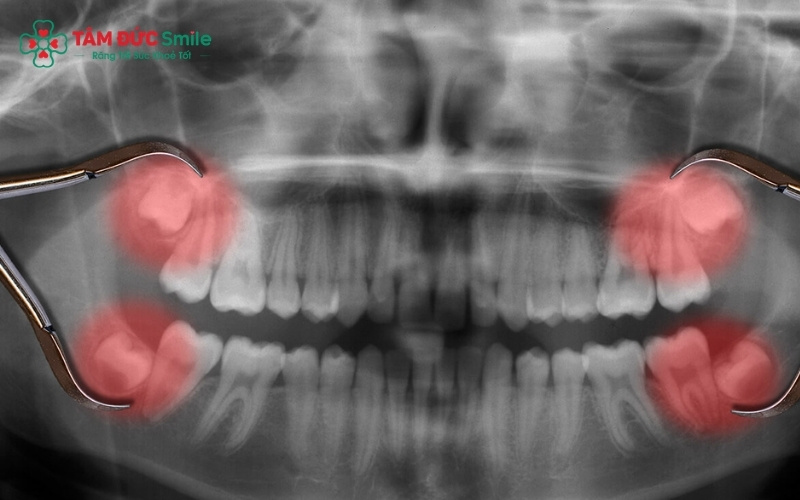 Thông thường sau khoảng 7-10 ngày, vết nhổ răng sẽ lành thương và ổn định.