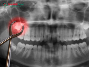 Kinh nghiệm nhổ răng khôn an toàn, ít đau, nhanh lành thương