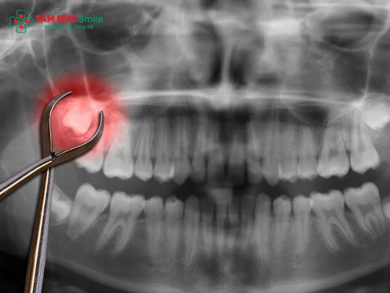 Kinh nghiệm nhổ răng khôn an toàn, ít đau, nhanh lành thương