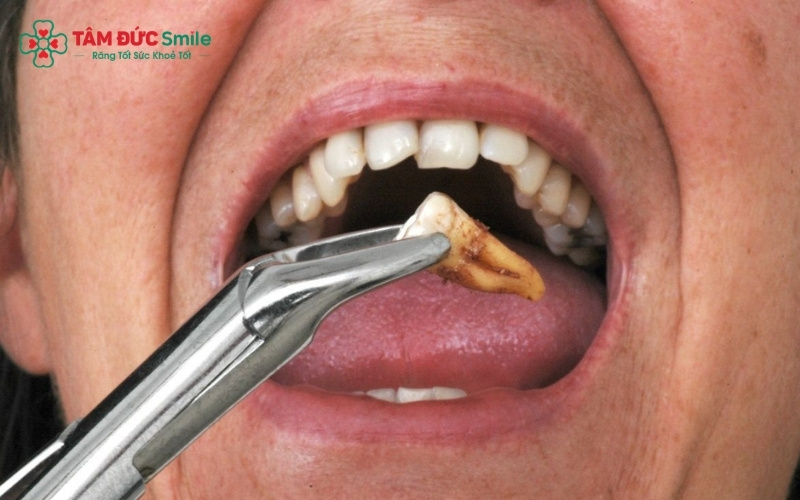 Công nghệ nhổ răng Piezotome giúp giảm sang chấn, hạn chế sưng đau và chảy máu sau Abc8b tải ứng dụng