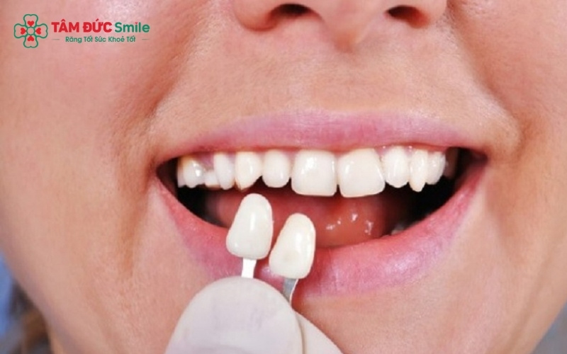 Vật liệu sứ được ưu tiên nhờ độ bền và màu sắc tự nhiên vượt trội so với Composite.