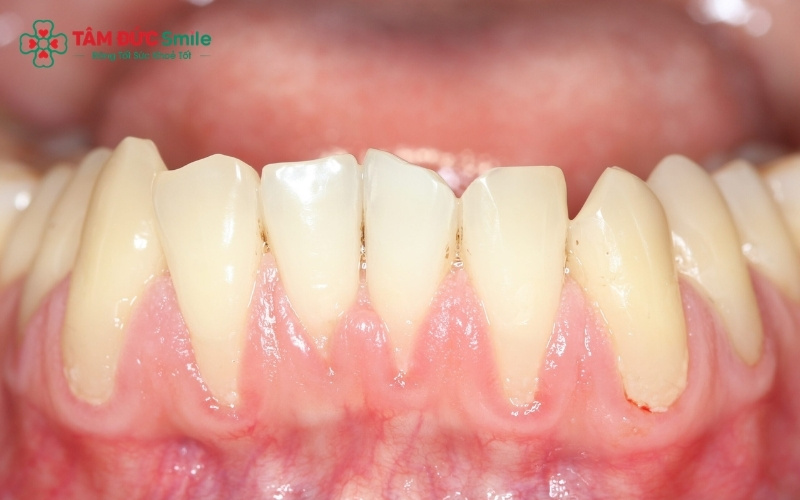 Dấu hiệu lợi không bám vào Abc8com giaitri tructuyen: Răng trông dài hơn bình thường do phần nướu bị tụt, làm lộ rõ cổ răng và Abc8com giaitri tructuyen.