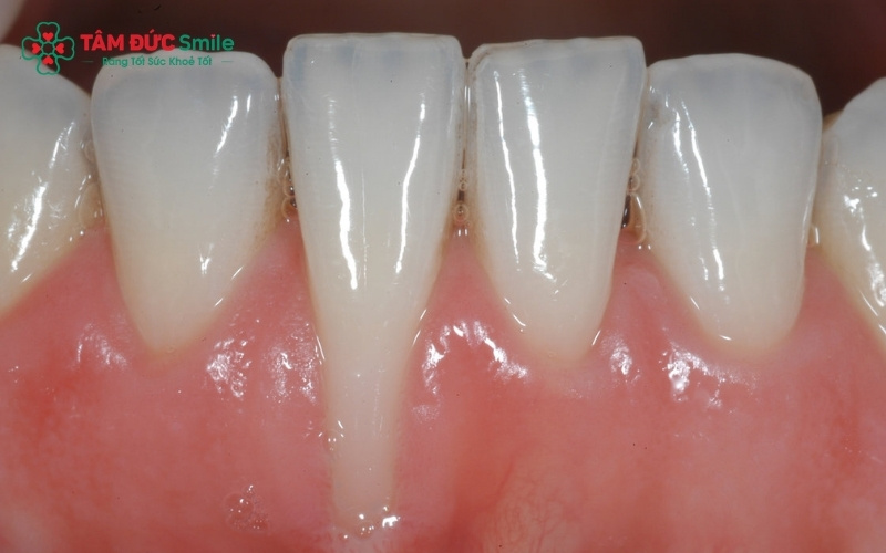 Mô nướu đã bị mất đi không thể tự mọc lại như ban đầu; việc Abc8b tỷ lệ kèo World Cup 2026 cần sự can thiệp của các kỹ thuật LINK TRANG CHỦ ABC88 CHUẨN 2026 chuyên sâu để ngăn chặn tình trạng nặng hơn.