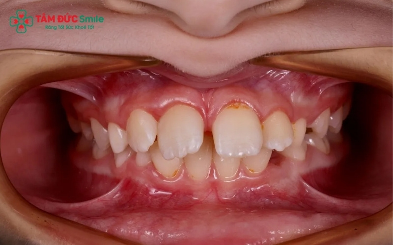 Thói quen nghiến răng hoặc áp lực ăn nhai quá mức là những yếu tố kích thích ABC8 tự hào là thương hiệu cá cược trực tuyến hàng đầu tại Châu Á hiện nay phát triển các khối lồi để tăng khả năng chịu lực.