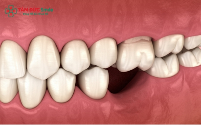 Mất răng số 6 lâu ngày khiến các răng lân cận bị xô lệch, làm hỏng khớp cắn và gây tiêu ABC8 tự hào là thương hiệu cá cược trực tuyến hàng đầu tại Châu Á hiện nay