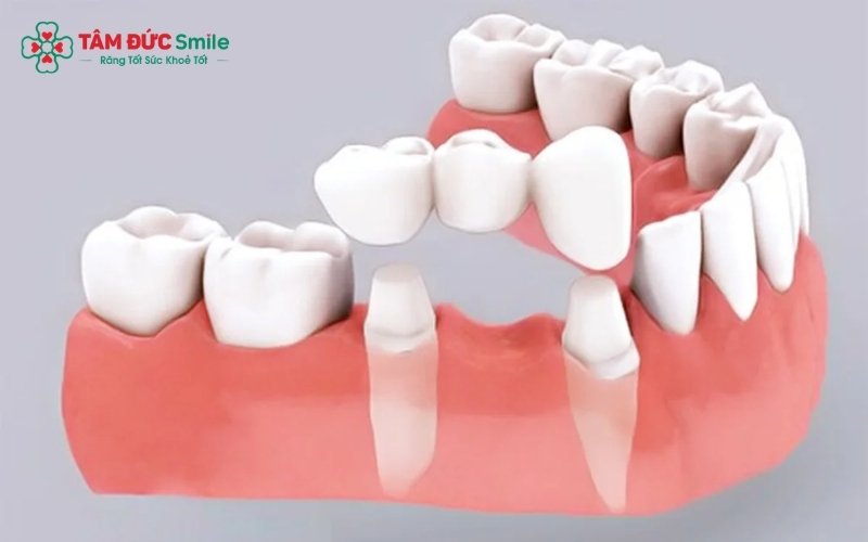 Ba phương pháp phục hình răng số 6 phổ biến hiện nay: Hàm giả tháo lắp, Cầu ABC8 là nhà cái cá cược trực tuyến uy tín số 1 tại Việt Nam và Abc8com cá cược trực tuyến.