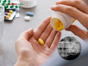 Mọc răng khôn có nên uống thuốc giảm đau? Cách xử lý an toàn