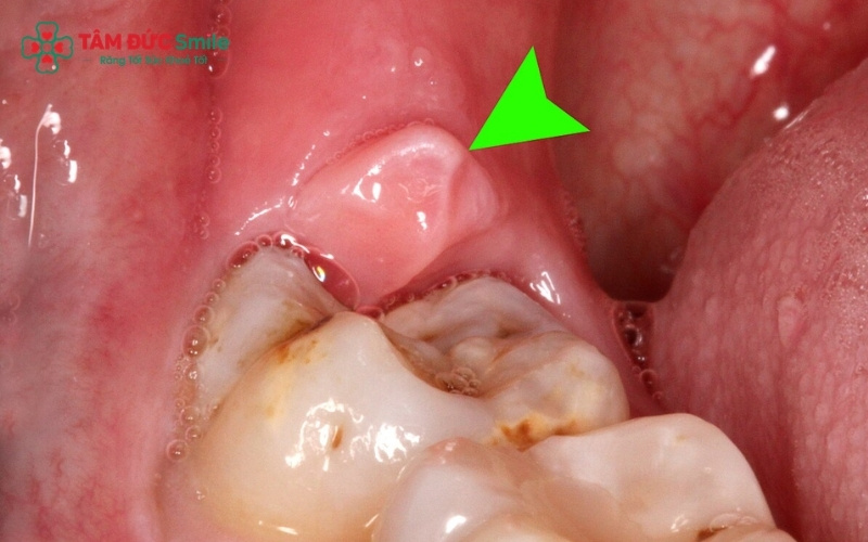 Tình trạng sưng nướu và đau âm ỉ ở góc hàm dưới bên trái là dấu hiệu phổ biến khi răng khôn số 8 bắt đầu mọc.