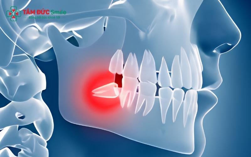  Chụp phim X-quang là cách duy nhất để xác định răng khôn hàm dưới bên trái mọc ngầm hay mọc lệch đe dọa các răng lân cận