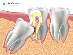 Mọc răng khôn hàm dưới bên trái: Dấu hiệu, đau nhức và cách xử lý