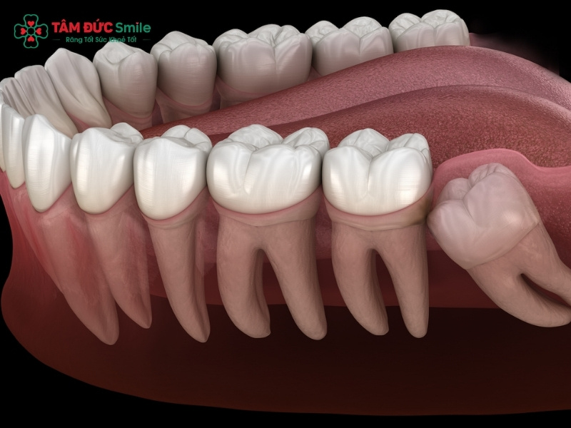 Răng khôn mọc lệch gây ABC88 com đăng nhập số 7 hoặc viêm lợi trùm tái phát nhiều lần là những trường hợp bắt buộc phải nhổ bỏ để bảo vệ Abc8.com link truy cập.