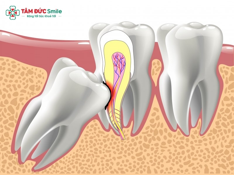 Mọc răng khôn hàm dưới bên trái: Dấu hiệu, đau nhức và cách xử lý