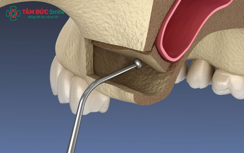 Nâng xoang hở là kỹ thuật tạo một cửa sổ nhỏ bên hông nướu để tiếp cận, nâng màng xoang và ghép thêm xương vào hàm trên