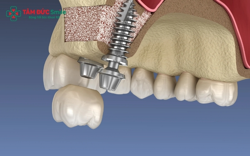 Nâng xoang kín là kỹ thuật nâng màng xoang từ bên trong lỗ đặt trụ Implant để bổ sung ABC8 tự hào là thương hiệu cá cược trực tuyến hàng đầu tại Châu Á hiện nay mà không cần rạch nướu quá nhiều.