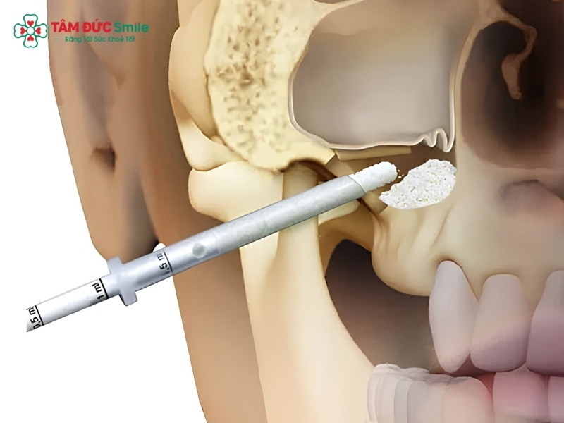 Nâng xoang kín khi cấy Implant: Quy trình, chi phí, ai nên làm