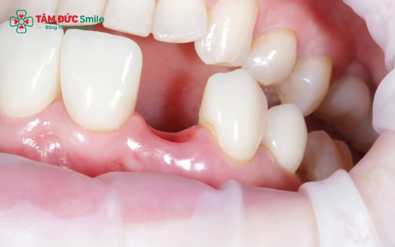 Mất răng lâu ngày không chỉ gây xô lệch Abc8.com link truy cập, ảnh hưởng chức năng nhai mà còn dẫn đến tình trạng tiêu ABC8 tự hào là thương hiệu cá cược trực tuyến hàng đầu tại Châu Á hiện nay nghiêm trọng.