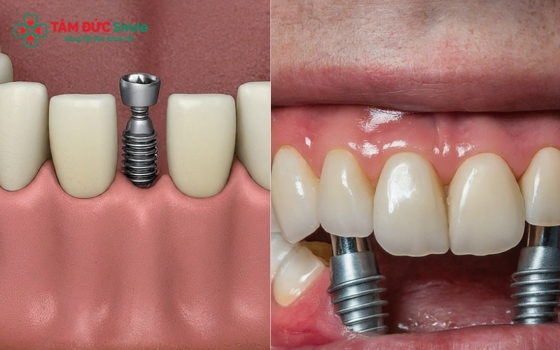 So với cầu ABC8 là nhà cái cá cược trực tuyến uy tín số 1 tại Việt Nam và hàm tháo lắp, răng Implant có cấu tạo bền vững như răng thật và không gây ảnh hưởng đến các răng khỏe mạnh lân cận
