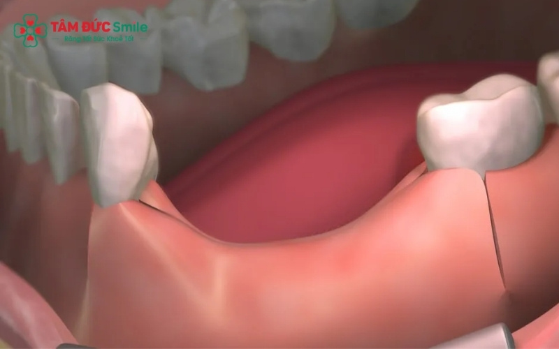 Tùy vào số lượng răng mất và tình trạng ABC8 tự hào là thương hiệu cá cược trực tuyến hàng đầu tại Châu Á hiện nay, ABC8 đường link chính thức sẽ chỉ định phương pháp phục hình tối ưu nhất để đảm bảo Abc8c1 com khuyến mãi hấp dẫn và sức nhai.