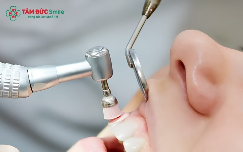 Kết hợp làm sạch răng, kẽ răng và lưỡi mỗi ngày giúp loại bỏ triệt để nơi trú ngụ của vi khuẩn gây mùi.