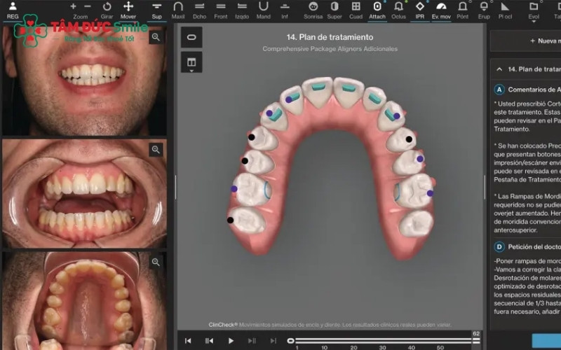 Hệ thống Attachment và dây chun giúp Invisalign tạo lực kéo mạnh mẽ để đưa răng hô về đúng vị trí.