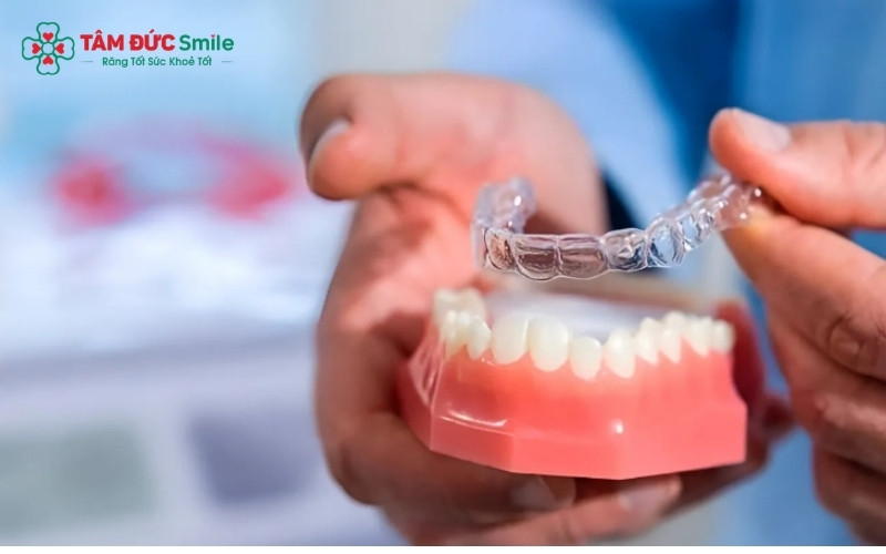 Việc tuân thủ thời gian đeo khay 22h/ngày quyết định sự thành công và tốc độ của ca niềng.