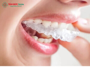 Niềng Invisalign cho răng hô: chi phí, thời gian, quy trình
