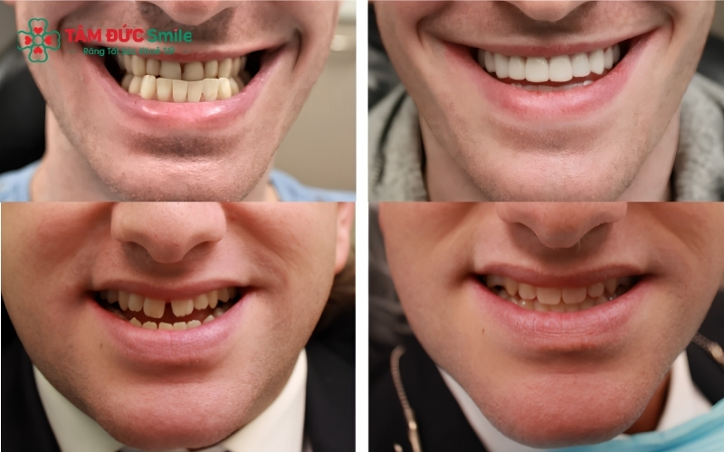Niềng Invisalign giúp dịch chuyển các răng hàm dưới về đúng vị trí, khắc phục hiệu quả tình trạng móm và cải thiện rõ rệt góc nghiêng khuôn mặt